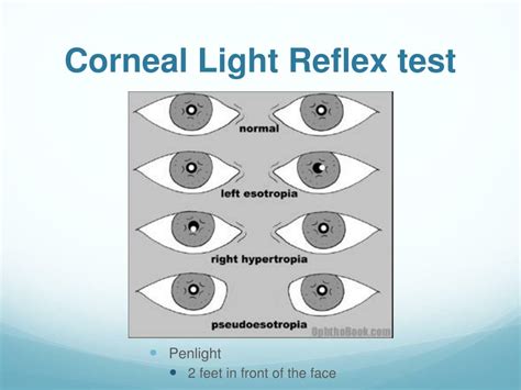 Corneal Light Reflex Testing for Strabismus and Amblyopia.